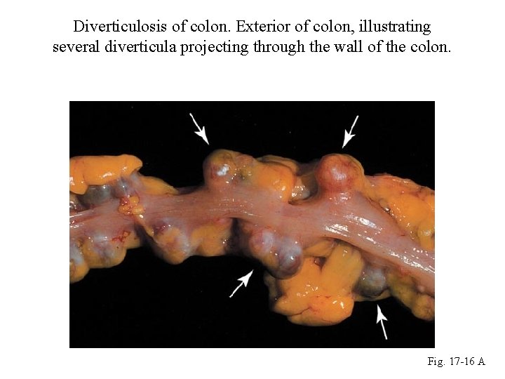 Diverticulosis of colon. Exterior of colon, illustrating several diverticula projecting through the wall of