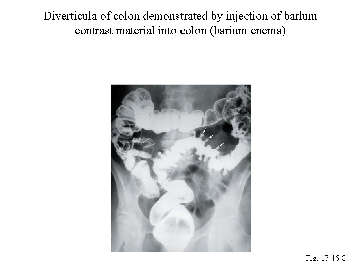 Diverticula of colon demonstrated by injection of barlum contrast material into colon (barium enema)