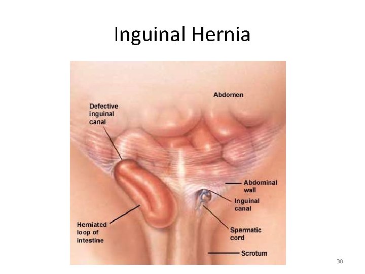 Inguinal Hernia 30 