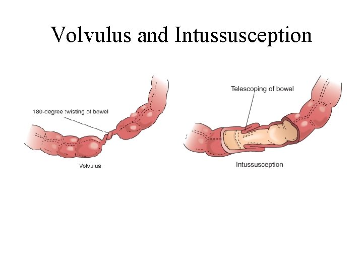 Volvulus and Intussusception 