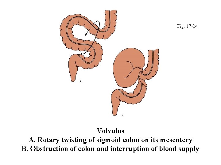 Fig. 17 -24 Volvulus A. Rotary twisting of sigmoid colon on its mesentery B.