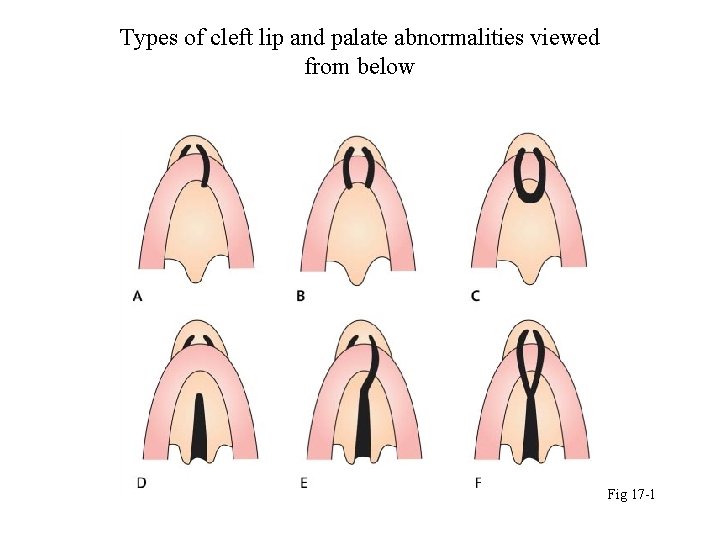 Types of cleft lip and palate abnormalities viewed from below Fig 17 -1 
