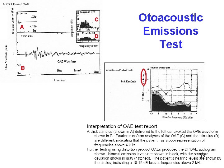 C A D Otoacoustic Emissions Test B 12 