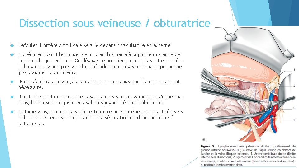Dissection sous veineuse / obturatrice Refouler l’artère ombilicale vers le dedans / vsx iliaque