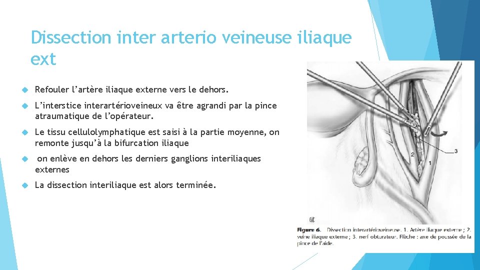 Dissection inter arterio veineuse iliaque ext Refouler l’artère iliaque externe vers le dehors. L’interstice