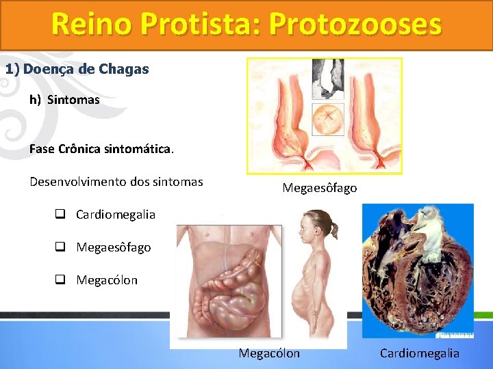 Reino Protista: Protozooses 1) Doença de Chagas h) Sintomas Fase Crônica sintomática. Desenvolvimento dos Reino Protista: Protozooses 1) Doença de Chagas h) Sintomas Fase Crônica sintomática. Desenvolvimento dos