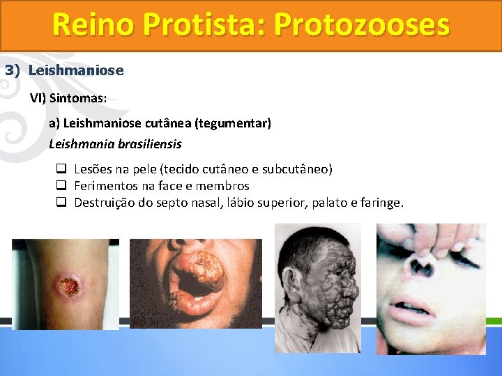 Reino Protista: Protozooses 3) Leishmaniose VI) Sintomas: a) Leishmaniose cutânea (tegumentar) Leishmania brasiliensis q Reino Protista: Protozooses 3) Leishmaniose VI) Sintomas: a) Leishmaniose cutânea (tegumentar) Leishmania brasiliensis q
