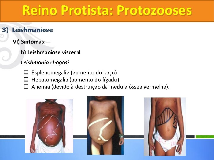 Reino Protista: Protozooses 3) Leishmaniose VI) Sintomas: b) Leishmaniose visceral Leishmania chagasi q Esplenomegalia Reino Protista: Protozooses 3) Leishmaniose VI) Sintomas: b) Leishmaniose visceral Leishmania chagasi q Esplenomegalia