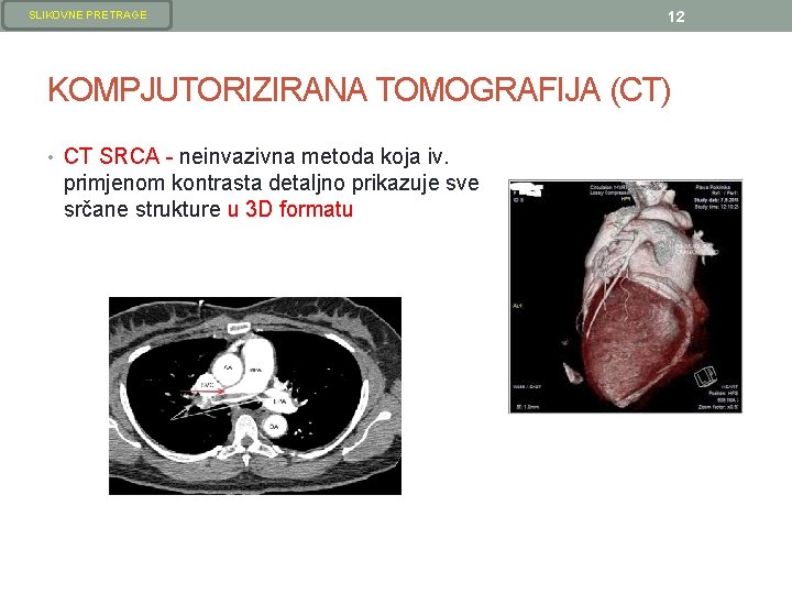 SLIKOVNE PRETRAGE 12 KOMPJUTORIZIRANA TOMOGRAFIJA (CT) • CT SRCA - neinvazivna metoda koja iv. SLIKOVNE PRETRAGE 12 KOMPJUTORIZIRANA TOMOGRAFIJA (CT) • CT SRCA - neinvazivna metoda koja iv.