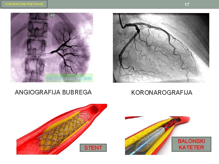 17 KONTRASTNE PRETRAGE ANGIOGRAFIJA BUBREGA STENT KORONAROGRAFIJA BALONSKI KATETER 17 KONTRASTNE PRETRAGE ANGIOGRAFIJA BUBREGA STENT KORONAROGRAFIJA BALONSKI KATETER