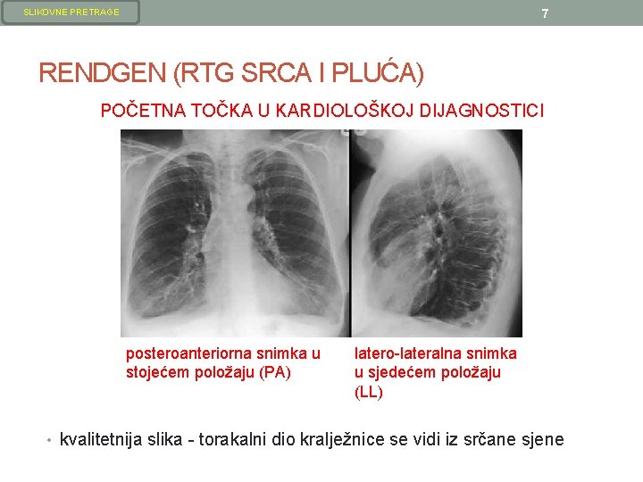 7 SLIKOVNE PRETRAGE RENDGEN (RTG SRCA I PLUĆA) POČETNA TOČKA U KARDIOLOŠKOJ DIJAGNOSTICI posteroanteriorna 7 SLIKOVNE PRETRAGE RENDGEN (RTG SRCA I PLUĆA) POČETNA TOČKA U KARDIOLOŠKOJ DIJAGNOSTICI posteroanteriorna