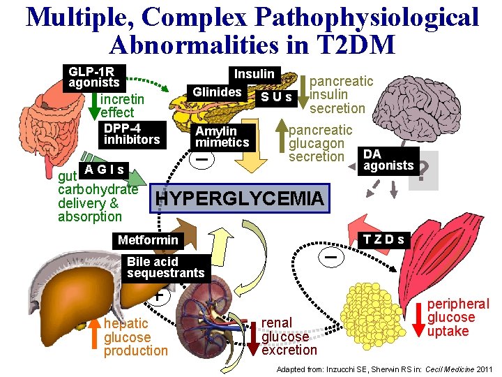 Multiple, Complex Pathophysiological Abnormalities in T 2 DM GLP-1 R agonists Insulin Glinides S