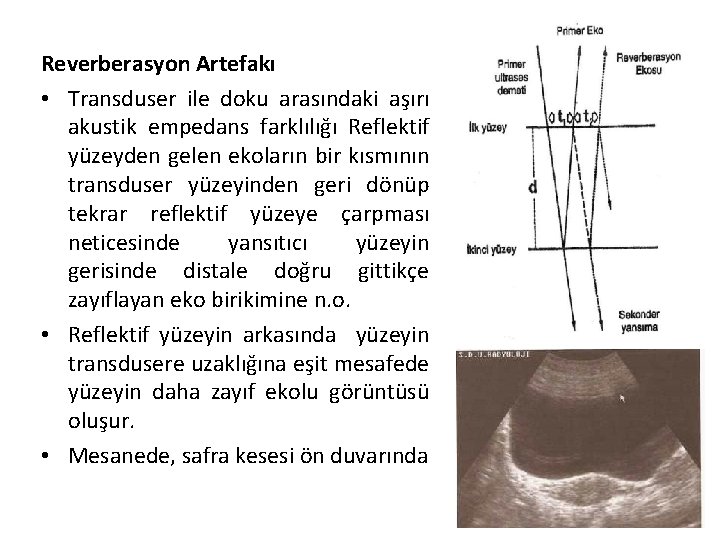 Reverberasyon Artefakı • Transduser ile doku arasındaki aşırı akustik empedans farklılığı Reflektif yüzeyden gelen