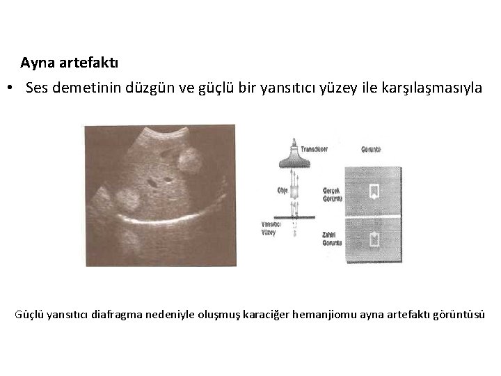 Ayna artefaktı • Ses demetinin düzgün ve güçlü bir yansıtıcı yüzey ile karşılaşmasıyla Güçlü