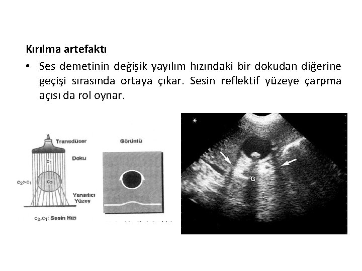 Kırılma artefaktı • Ses demetinin değişik yayılım hızındaki bir dokudan diğerine geçişi sırasında ortaya