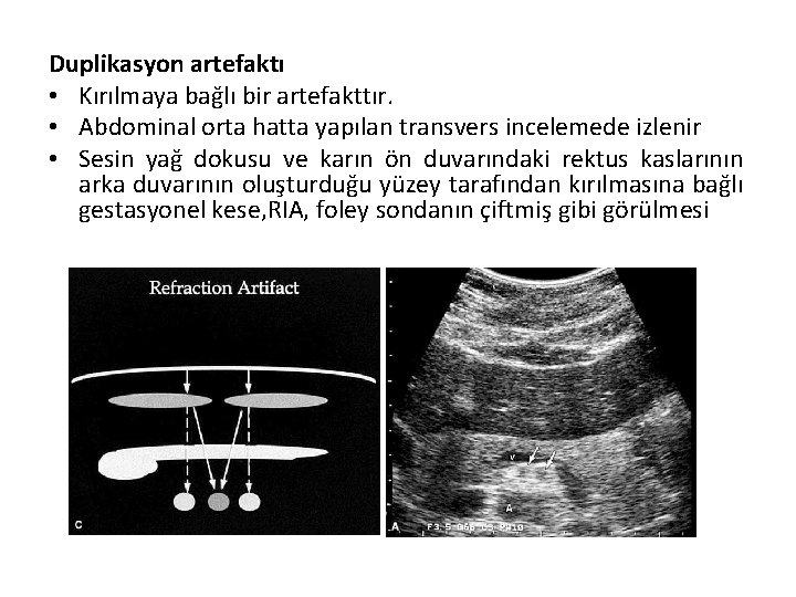 Duplikasyon artefaktı • Kırılmaya bağlı bir artefakttır. • Abdominal orta hatta yapılan transvers incelemede