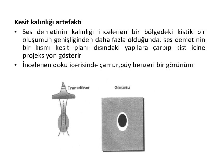 Kesit kalınlığı artefaktı • Ses demetinin kalınlığı incelenen bir bölgedeki kistik bir oluşumun genişliğinden