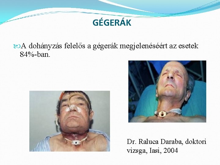 GÉGERÁK A dohányzás felelős a gégerák megjelenéséért az esetek 84%-ban. Dr. Raluca Daraba, doktori