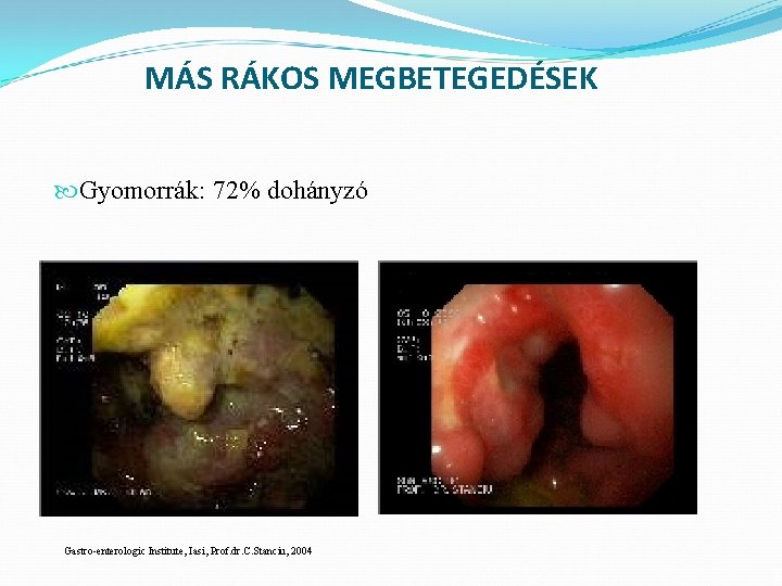 MÁS RÁKOS MEGBETEGEDÉSEK Gyomorrák: 72% dohányzó Gastro-enterologic Institute, Iasi, Prof. dr. C. Stanciu, 2004