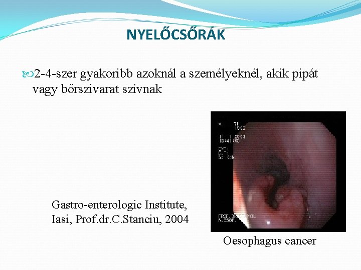 NYELŐCSŐRÁK 2 -4 -szer gyakoribb azoknál a személyeknél, akik pipát vagy bőrszivarat szívnak Gastro-enterologic