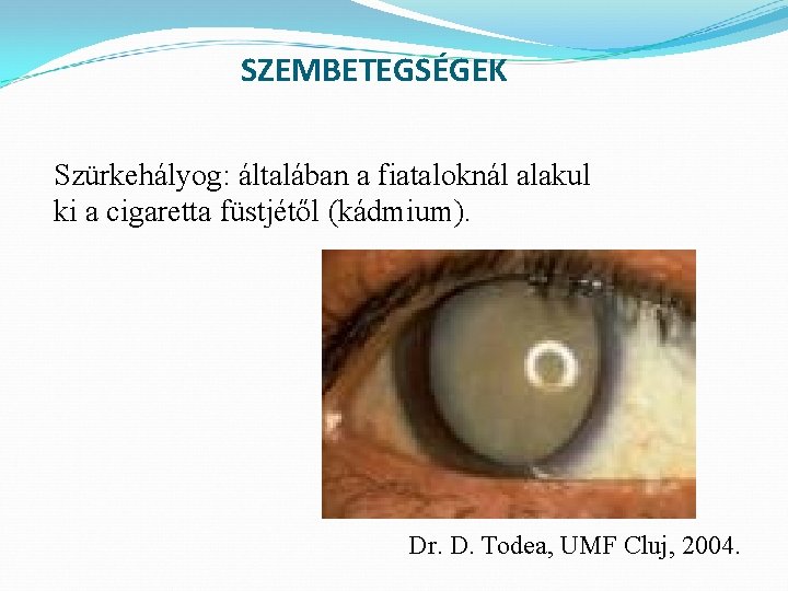 SZEMBETEGSÉGEK Szürkehályog: általában a fiataloknál alakul ki a cigaretta füstjétől (kádmium). Dr. D. Todea,