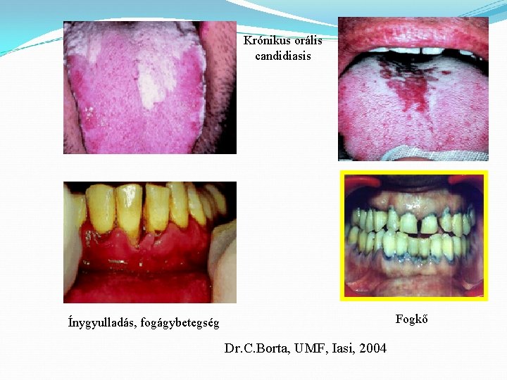Krónikus orális candidiasis Fogkő Ínygyulladás, fogágybetegség Dr. C. Borta, UMF, Iasi, 2004 