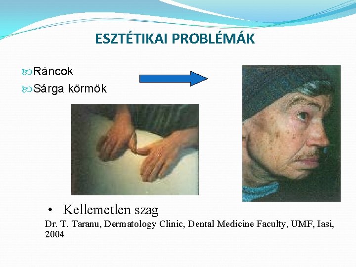 ESZTÉTIKAI PROBLÉMÁK Ráncok Sárga körmök • Kellemetlen szag Dr. T. Taranu, Dermatology Clinic, Dental