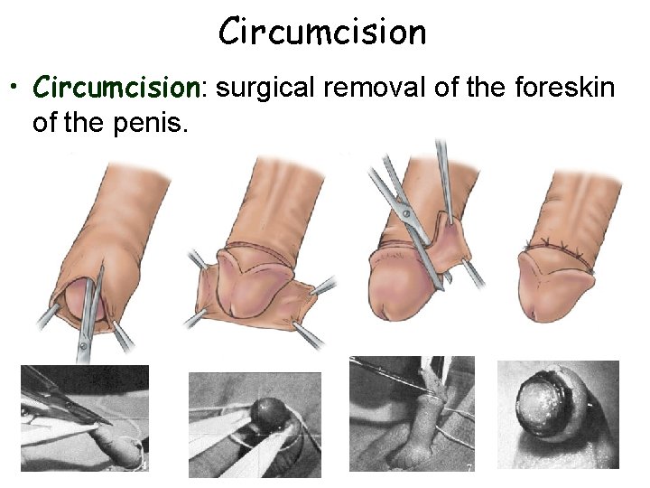 Circumcision • Circumcision: surgical removal of the foreskin of the penis. 
