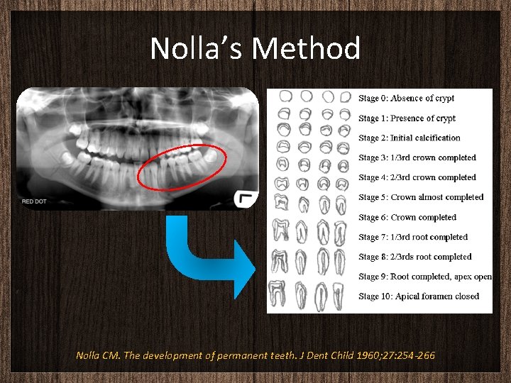 Nolla’s Method Nolla CM. The development of permanent teeth. J Dent Child 1960; 27: