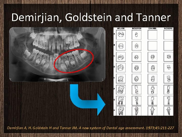 Demirjian, Goldstein and Tanner Demirjian A, H. Goldstein H and Tanner JM. A new