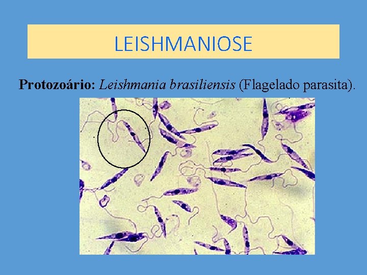 LEISHMANIOSE Protozoário: Leishmania brasiliensis (Flagelado parasita). 