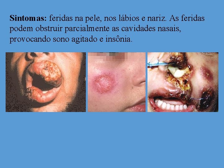 Sintomas: feridas na pele, nos lábios e nariz. As feridas podem obstruir parcialmente as