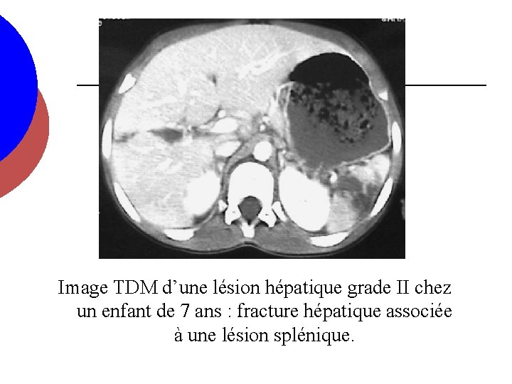 Image TDM d’une lésion hépatique grade II chez un enfant de 7 ans :