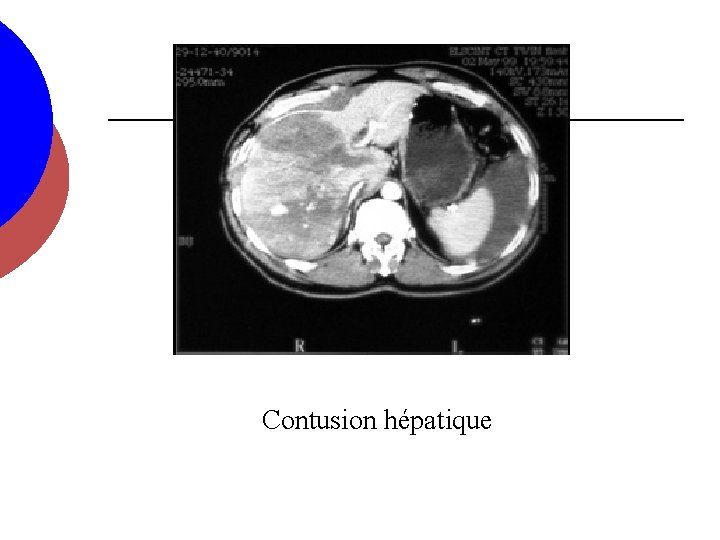 Contusion hépatique 