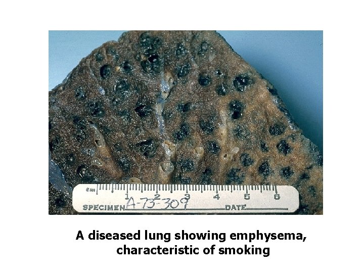 A diseased lung showing emphysema, characteristic of smoking 