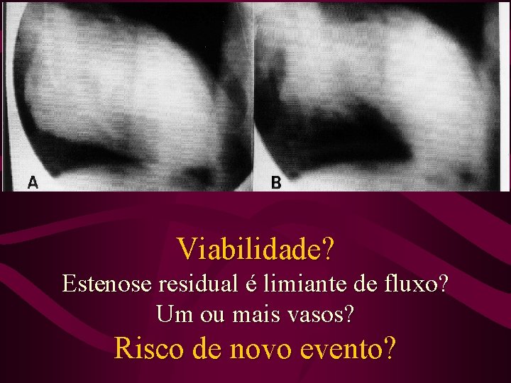 Viabilidade? Estenose residual é limiante de fluxo? Um ou mais vasos? Risco de novo