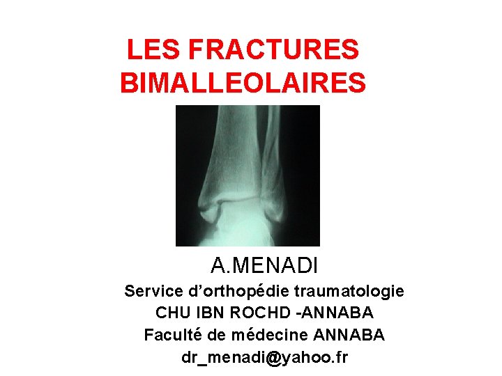 LES FRACTURES BIMALLEOLAIRES A. MENADI Service d’orthopédie traumatologie CHU IBN ROCHD -ANNABA Faculté de