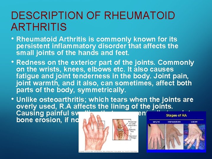 DESCRIPTION OF RHEUMATOID ARTHRITIS • Rheumatoid Arthritis is commonly known for its • •