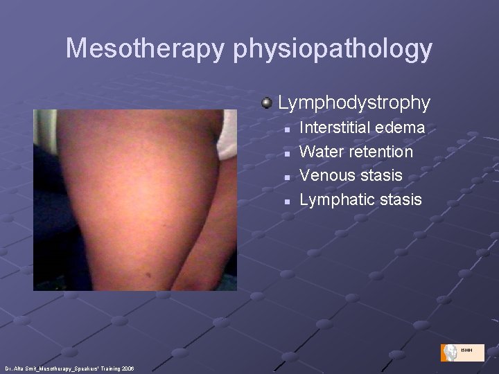 Mesotherapy physiopathology Lymphodystrophy n n Dr. Alta Smit_Mesotherapy_Speakers' Training 2006 Interstitial edema Water retention