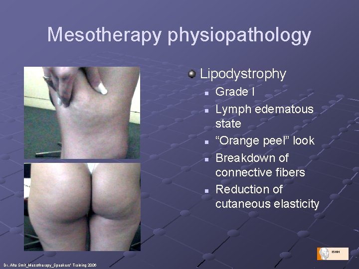 Mesotherapy physiopathology Lipodystrophy n n n Dr. Alta Smit_Mesotherapy_Speakers' Training 2006 Grade I Lymph