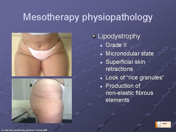 Mesotherapy physiopathology Lipodystrophy n n n Dr. Alta Smit_Mesotherapy_Speakers' Training 2006 Grade II Micronodular