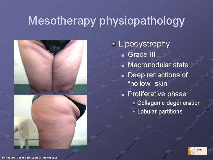 Mesotherapy physiopathology Lipodystrophy n n Grade III Macronodular state Deep retractions of “hollow” skin