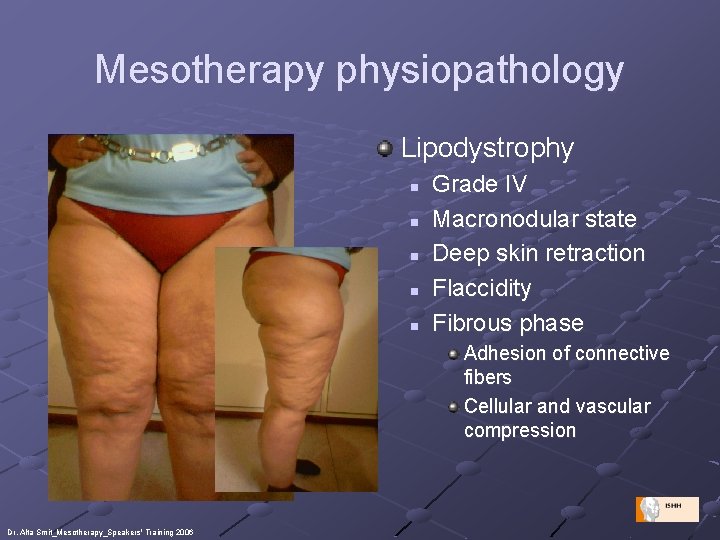 Mesotherapy physiopathology Lipodystrophy n n n Grade IV Macronodular state Deep skin retraction Flaccidity