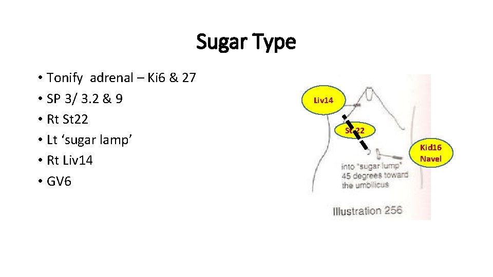 Sugar Type • Tonify adrenal – Ki 6 & 27 • SP 3/ 3.