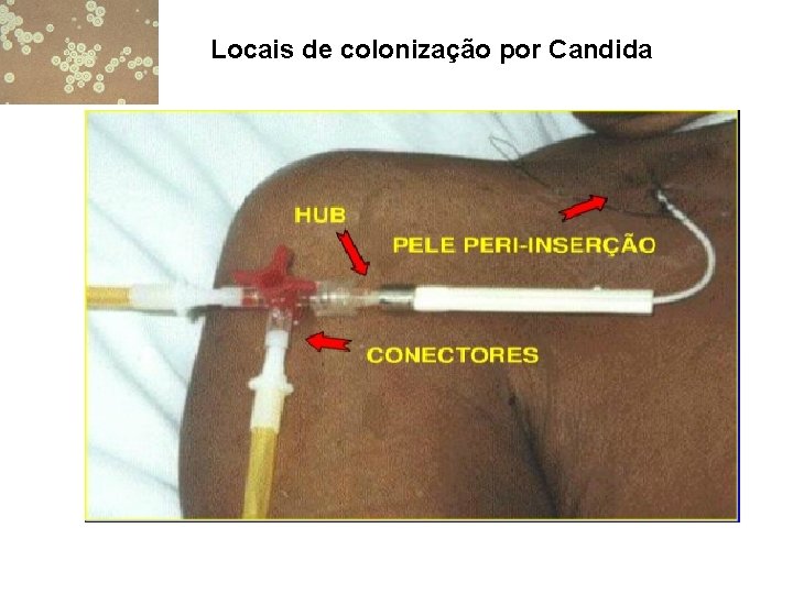 Locais de colonização por Candida 