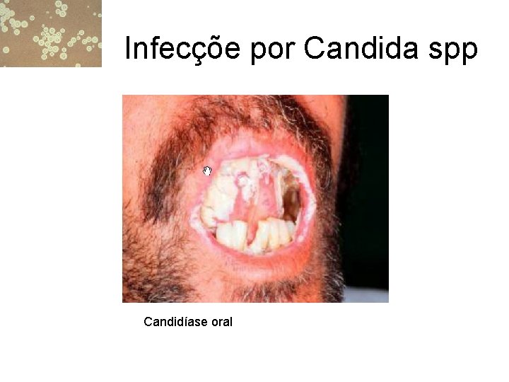 Infecçõe por Candida spp Candidíase oral 