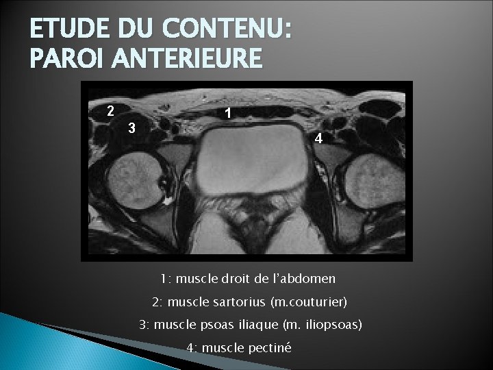 ETUDE DU CONTENU: PAROI ANTERIEURE 2 1 3 4 1: muscle droit de l’abdomen