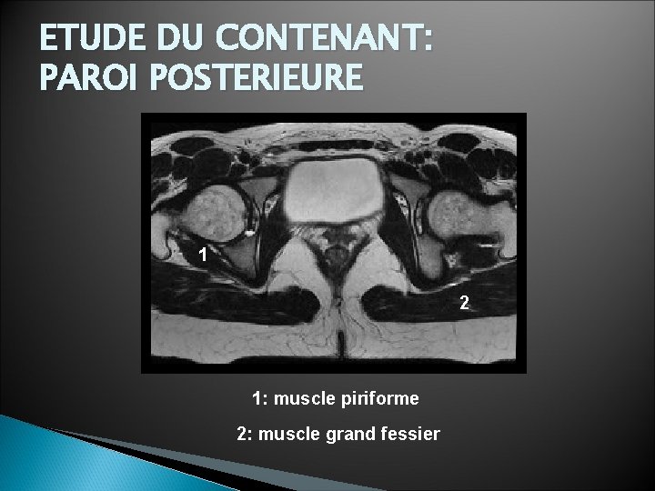 ETUDE DU CONTENANT: PAROI POSTERIEURE 1 2 1: muscle piriforme 2: muscle grand fessier