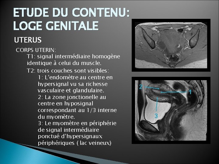 ETUDE DU CONTENU: LOGE GENITALE UTERUS CORPS UTERIN: T 1: signal intermédiaire homogène identique