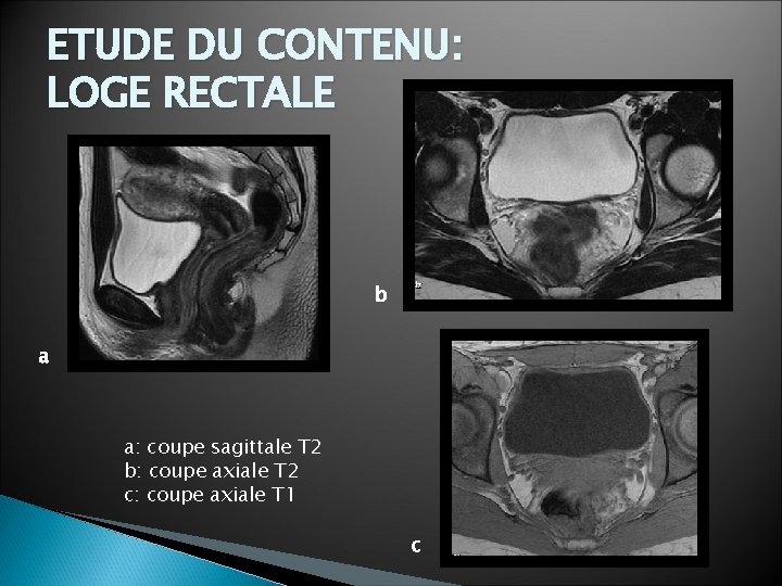 ETUDE DU CONTENU: LOGE RECTALE b a a: coupe sagittale T 2 b: coupe